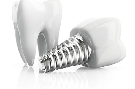 Dental Implants in Commerce Twp