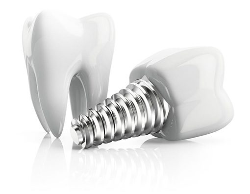  هزینه ایمپلنت دندان چقدره ؟
