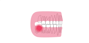 فشار دندان عقل به دندان های مجاور