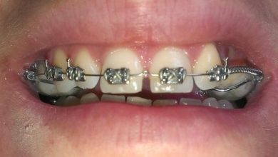 آیا با بریس ارتودنسی ممکن است فاصله بین دندان ها بیشتر شود؟