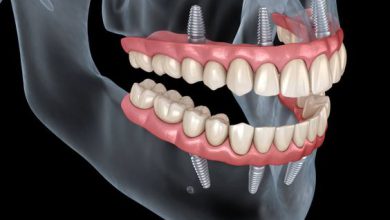 اطلاعاتی درباره ایمپلنت دندان که هیچکس به شما نمیگوید!