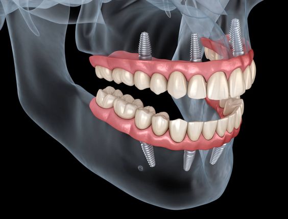 اطلاعاتی درباره ایمپلنت دندان که هیچکس به شما نمیگوید!