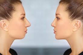 تاثیر جراحی فک بر بینی! واقعیت یا شایعه